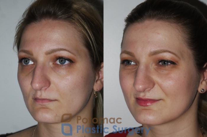 Before & After Rhinoplasty - Medical Case 175 Left Oblique View in Washington DC & Arlington , DC