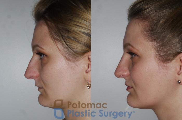 Before & After Rhinoplasty - Medical Case 175 Left Side View in Washington DC & Arlington , DC
