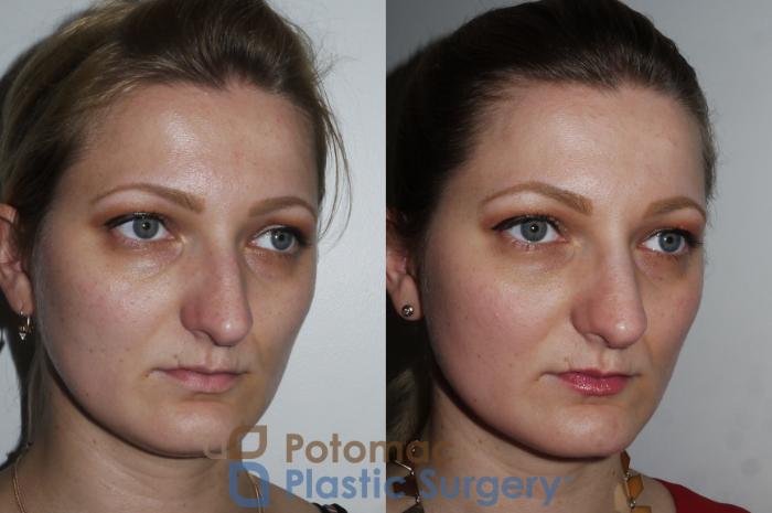 Before & After Rhinoplasty - Medical Case 175 Right Oblique View in Washington DC & Arlington , DC