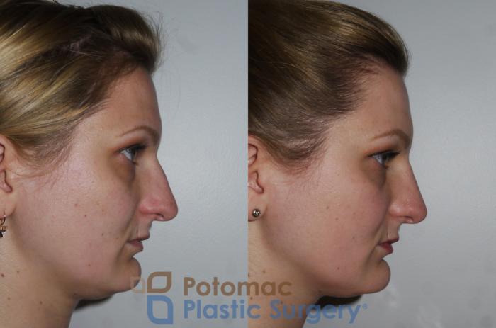Before & After Rhinoplasty - Cosmetic Case 175 Right Side View in Washington DC & Arlington , DC