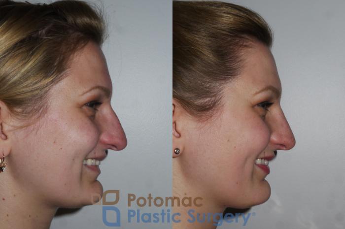 Before & After Rhinoplasty - Cosmetic Case 175 Right Side View #2 View in Washington DC & Arlington , DC