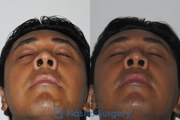 Before & After Rhinoplasty - Medical Case 179 Below View in Washington DC & Arlington , DC