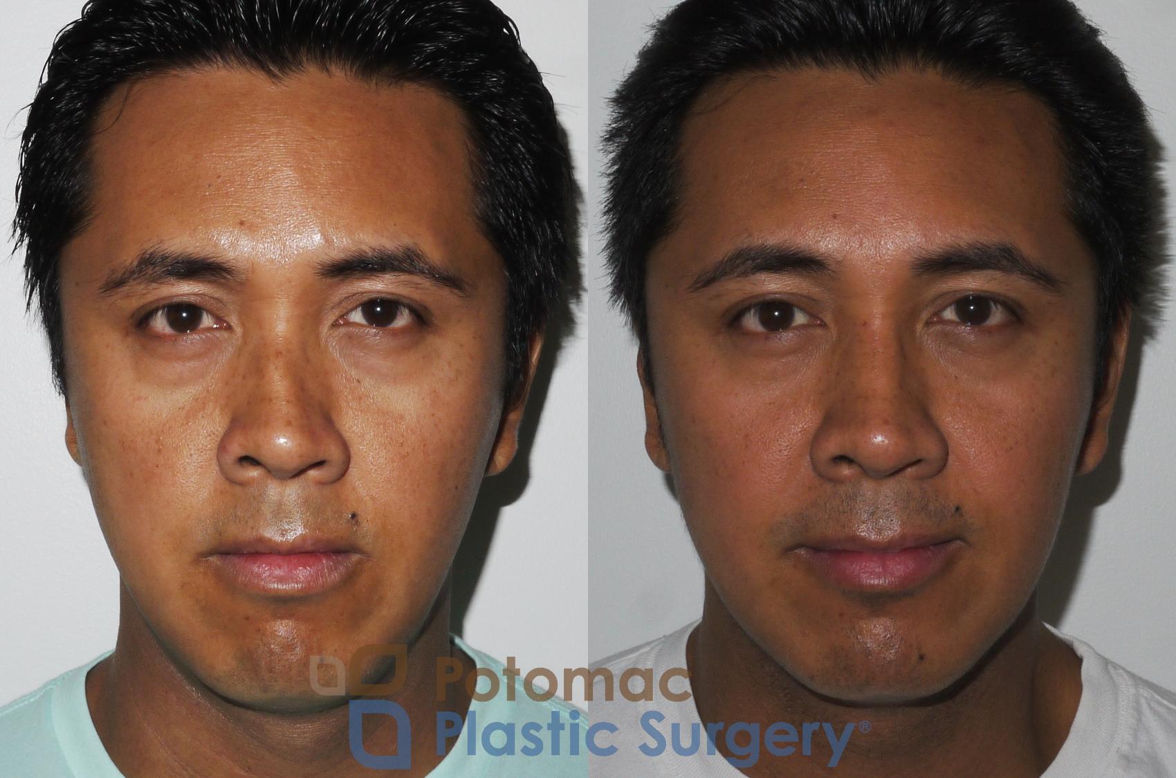 Before & After Rhinoplasty - Cosmetic Case 179 Front View in Washington, DC