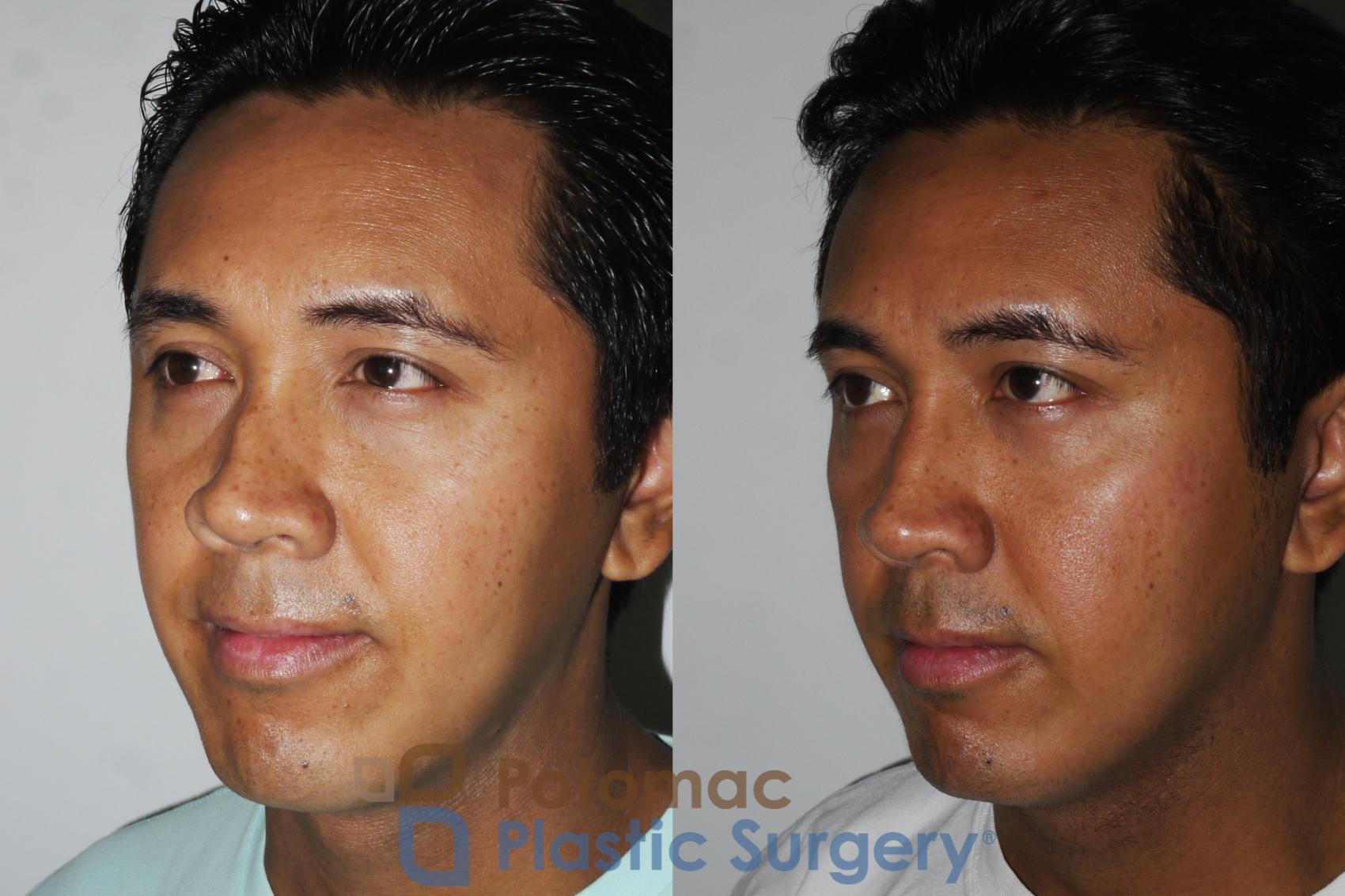Before & After Rhinoplasty - Cosmetic Case 179 Left Oblique View in Washington, DC