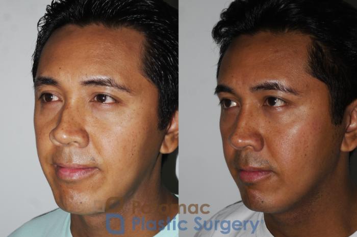 Before & After Rhinoplasty - Cosmetic Case 179 Left Oblique View in Washington DC & Arlington , DC