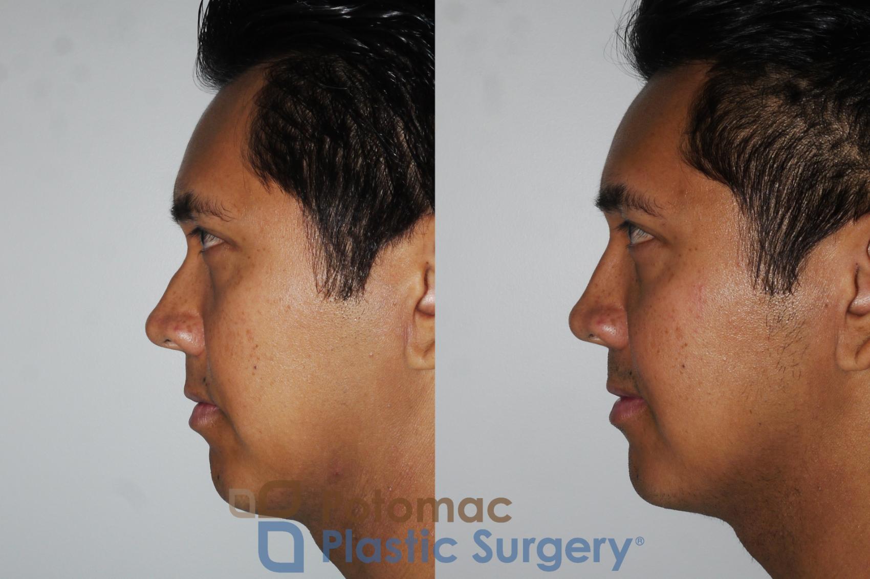 Before & After Rhinoplasty - Cosmetic Case 179 Left Side View in Washington, DC