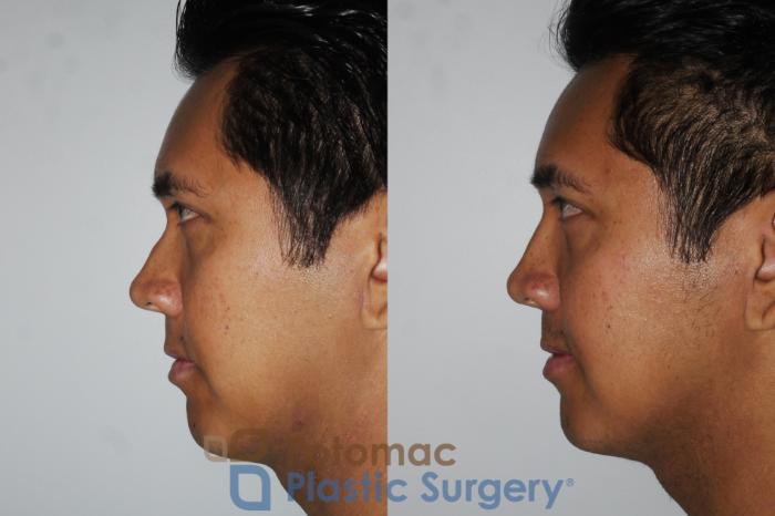 Before & After Rhinoplasty - Medical Case 179 Left Side View in Washington DC & Arlington , DC