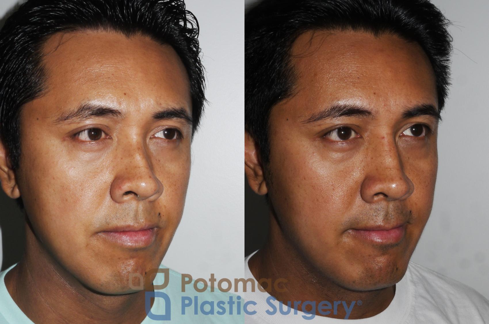 Before & After Rhinoplasty - Cosmetic Case 179 Right Oblique View in Washington, DC