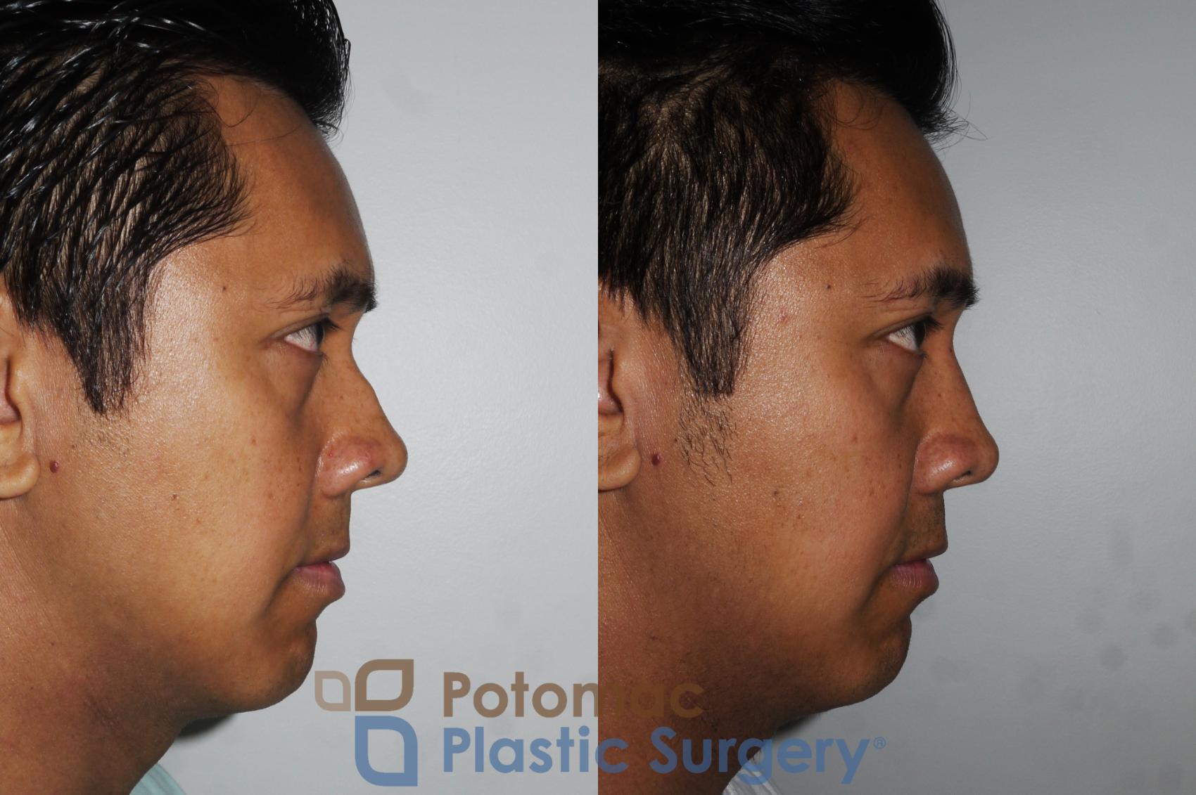 Before & After Rhinoplasty - Cosmetic Case 179 Right Side View in Washington, DC