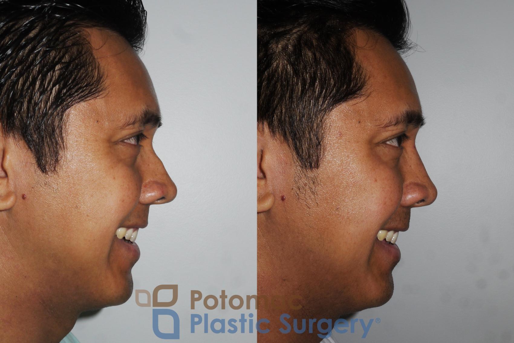 Before & After Rhinoplasty - Cosmetic Case 179 Right Side View #2 View in Washington, DC
