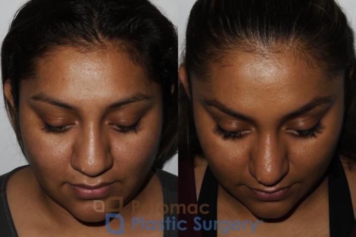 Before & After Rhinoplasty - Cosmetic Case 181 Above View in Washington DC & Arlington , DC