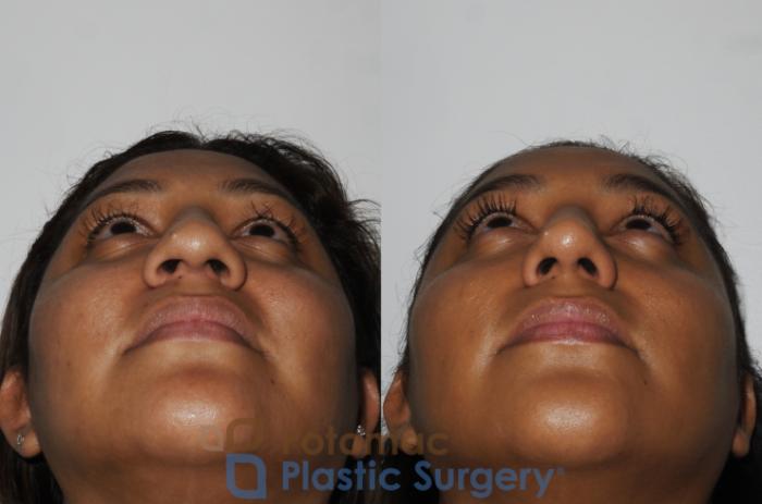Before & After Rhinoplasty - Cosmetic Case 181 Below View in Washington DC & Arlington , DC