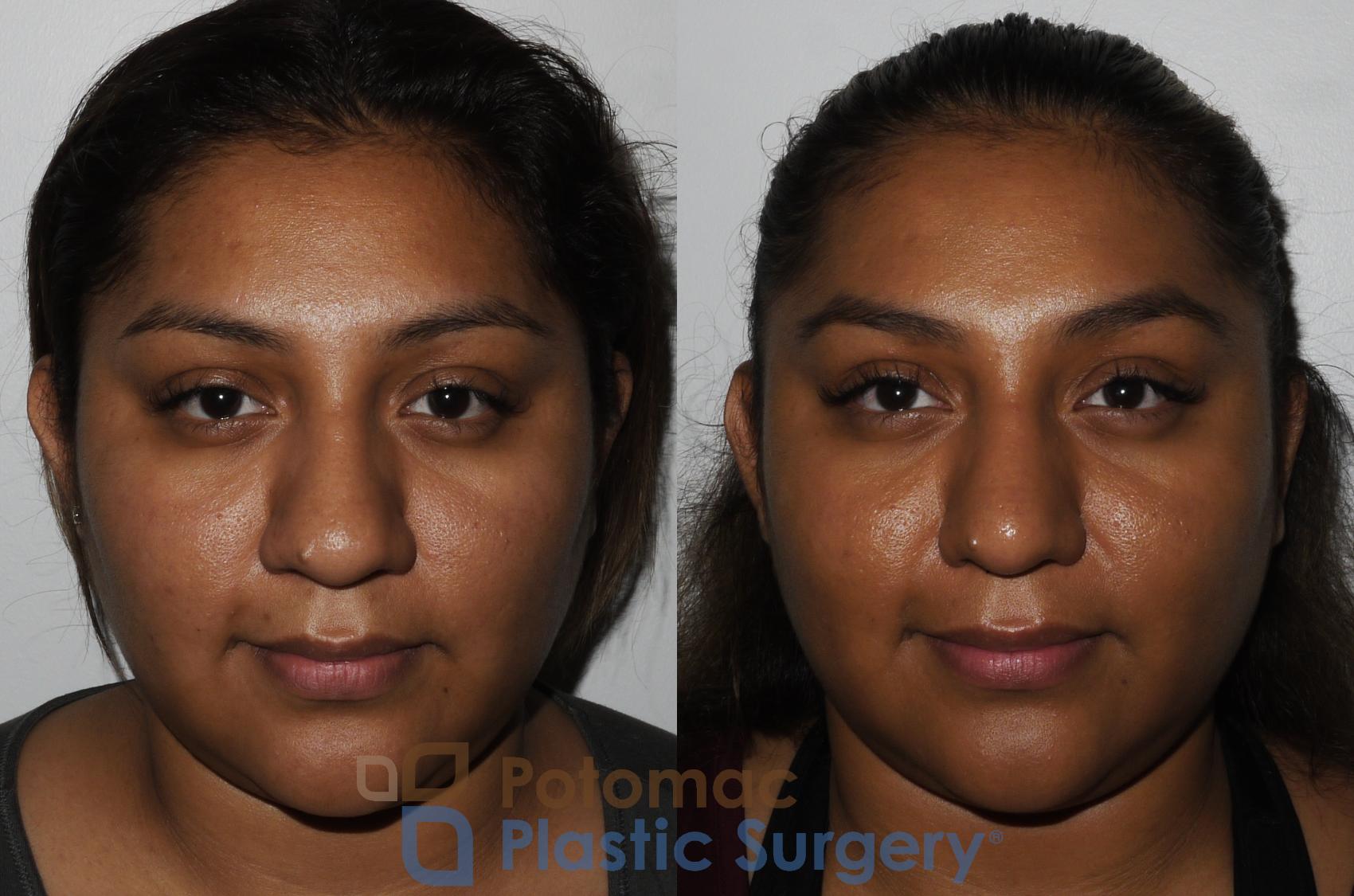 Before & After Rhinoplasty - Cosmetic Case 181 Front View in Washington DC & Arlington , DC