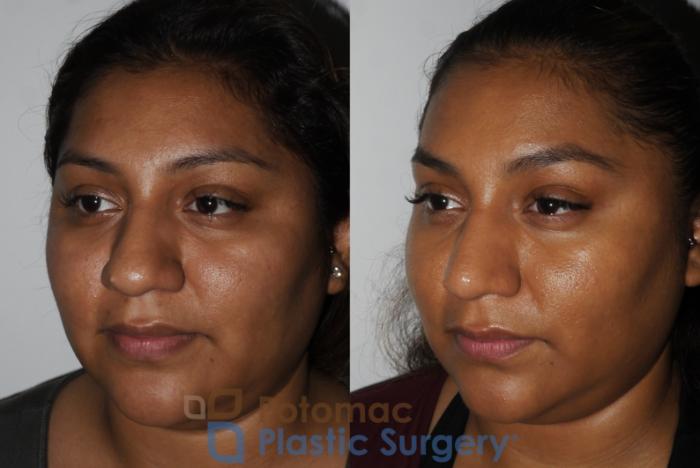 Before & After Rhinoplasty - Cosmetic Case 181 Left Oblique View in Washington DC & Arlington , DC