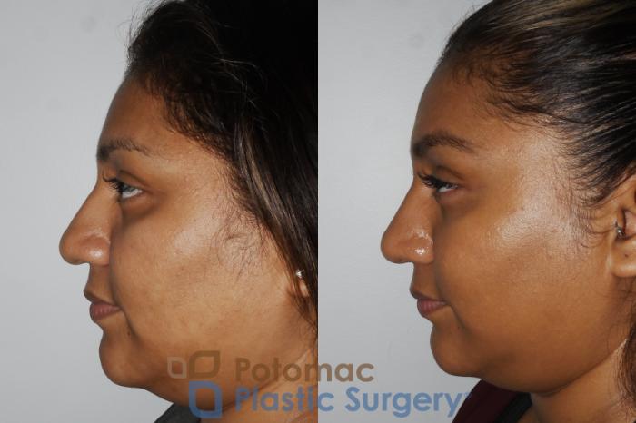 Before & After Rhinoplasty - Cosmetic Case 181 Left Side View in Washington DC & Arlington , DC
