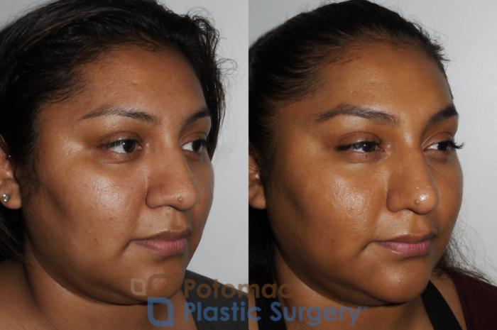 Before & After Rhinoplasty - Cosmetic Case 181 Right Oblique View in Washington DC & Arlington , DC