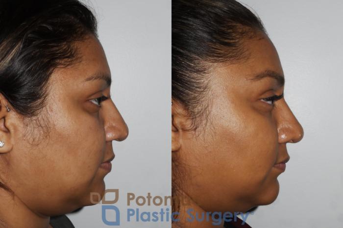 Before & After Rhinoplasty - Cosmetic Case 181 Right Side View in Washington DC & Arlington , DC