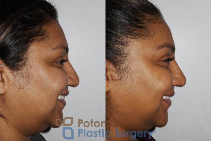 Before & After Rhinoplasty - Cosmetic Case 181 Right Side View #2 View in Washington DC & Arlington , DC