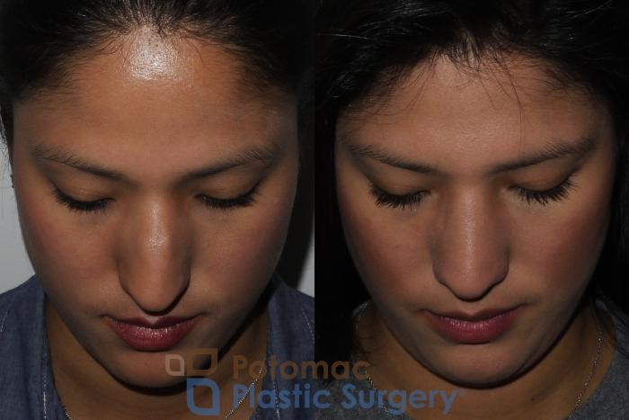 Before & After Rhinoplasty - Cosmetic Case 185 Above View in Washington DC & Arlington , DC