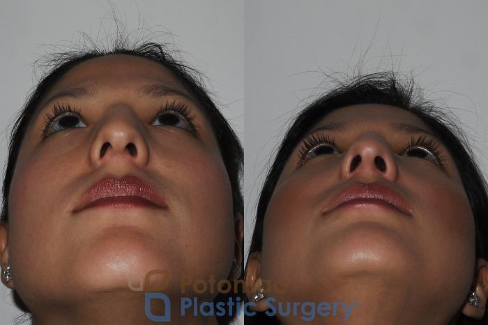 Before & After Rhinoplasty - Cosmetic Case 185 Below View in Washington DC & Arlington , DC