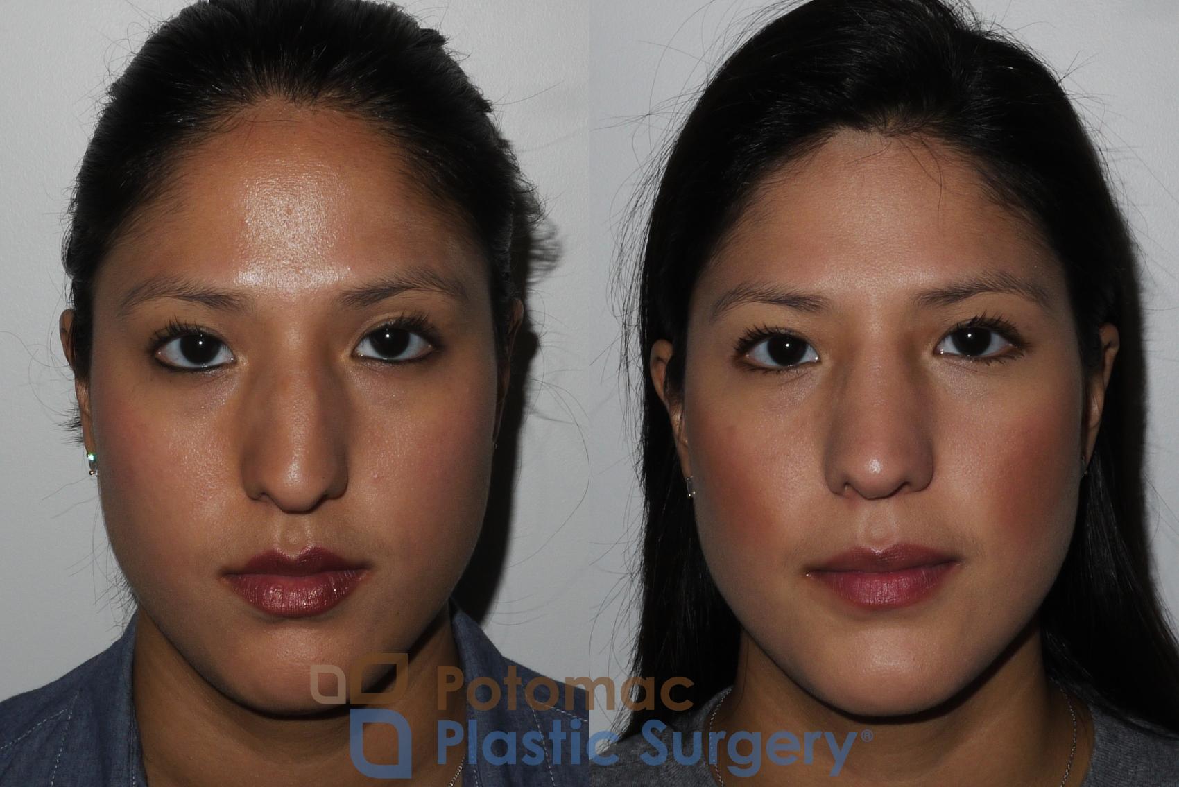 Before & After Rhinoplasty - Cosmetic Case 185 Front View #1 View in Washington DC & Arlington , DC