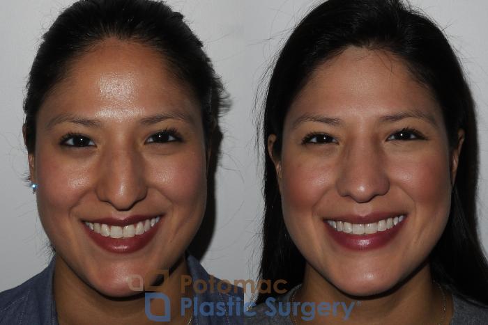 Before & After Rhinoplasty - Cosmetic Case 185 Front View #2 View in Washington DC & Arlington , DC