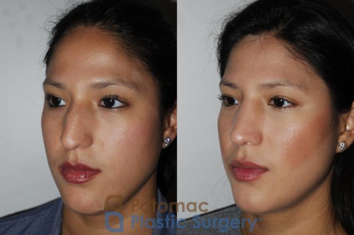 Before & After Rhinoplasty - Cosmetic Case 185 Left Oblique View in Washington DC & Arlington , DC