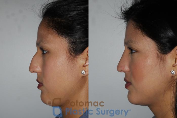 Before & After Rhinoplasty - Medical Case 185 Left Side View in Washington DC & Arlington , DC