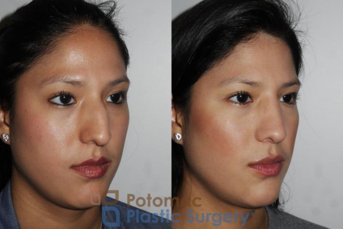 Before & After Rhinoplasty - Medical Case 185 Right Oblique View in Washington DC & Arlington , DC