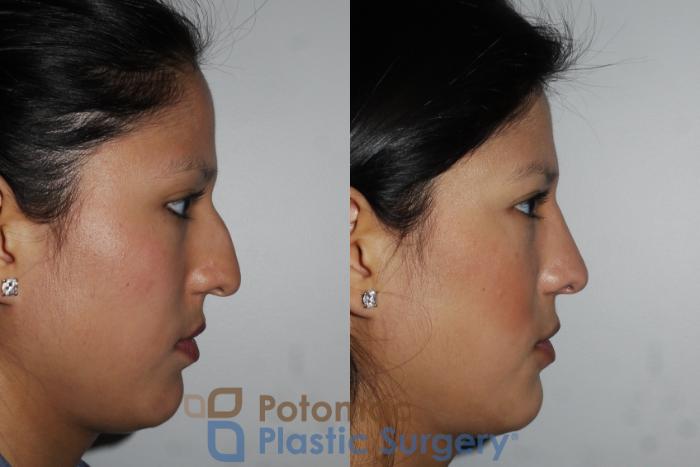 Before & After Rhinoplasty - Cosmetic Case 185 Right Side View in Washington DC & Arlington , DC