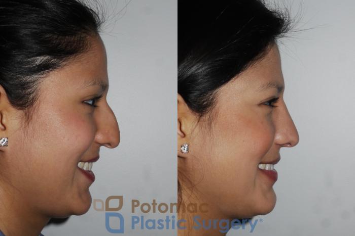 Before & After Rhinoplasty - Medical Case 185 Right Side View #2 View in Washington DC & Arlington , DC