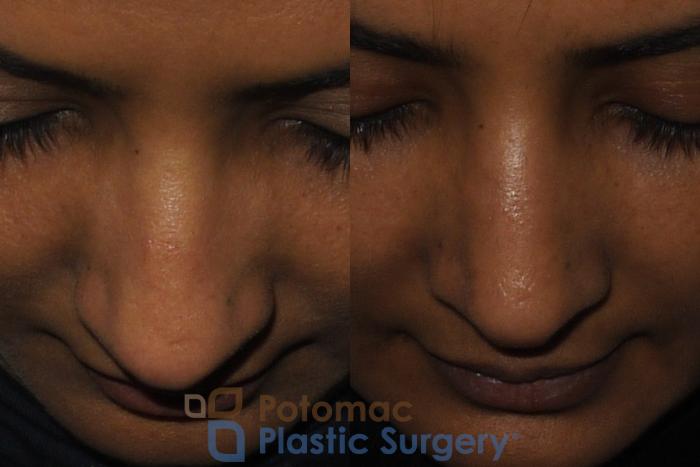 Before & After Rhinoplasty - Medical Case 186 Above View in Washington DC & Arlington , DC