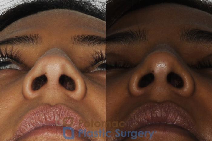 Before & After Rhinoplasty - Cosmetic Case 186 Below View in Washington DC & Arlington , DC