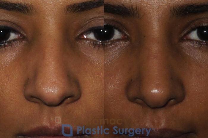 Before & After Rhinoplasty - Medical Case 186 Front View in Washington DC & Arlington , DC