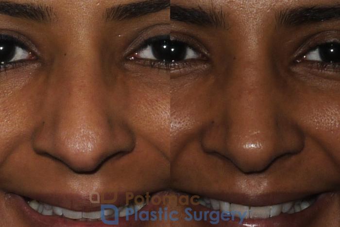 Before & After Rhinoplasty - Cosmetic Case 186 Front View #2 View in Washington DC & Arlington , DC