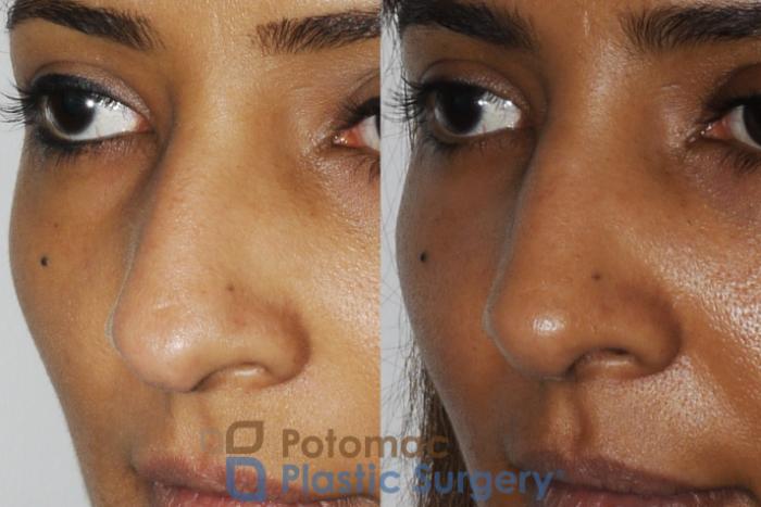Before & After Rhinoplasty - Medical Case 186 Left Oblique View in Washington DC & Arlington , DC