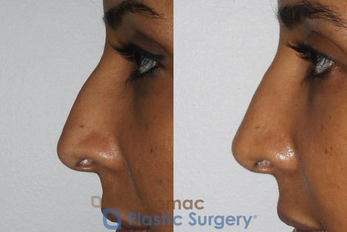 Before & After Rhinoplasty - Cosmetic Case 186 Left Side View in Washington DC & Arlington , DC