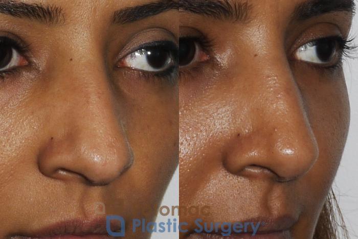 Before & After Rhinoplasty - Medical Case 186 Right Oblique View in Washington DC & Arlington , DC