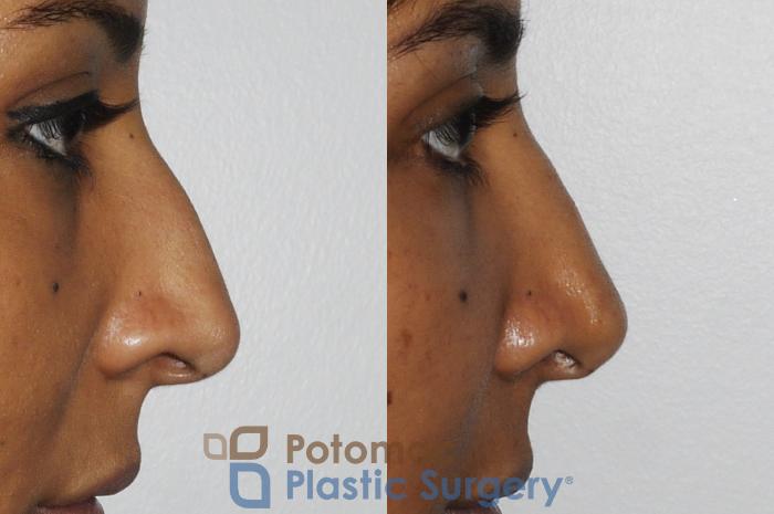 Before & After Rhinoplasty - Medical Case 186 Right Side View #1 View in Washington DC & Arlington , DC