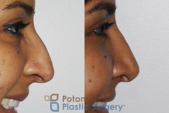 Before & After Rhinoplasty - Medical Case 186 Right Side View #2 View in Washington DC & Arlington , DC