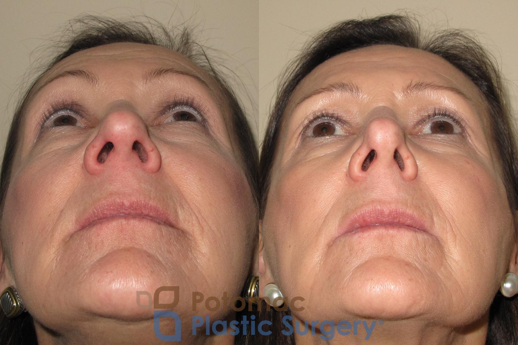 Before & After Rhinoplasty - Cosmetic Case 19 Below View in Washington, DC