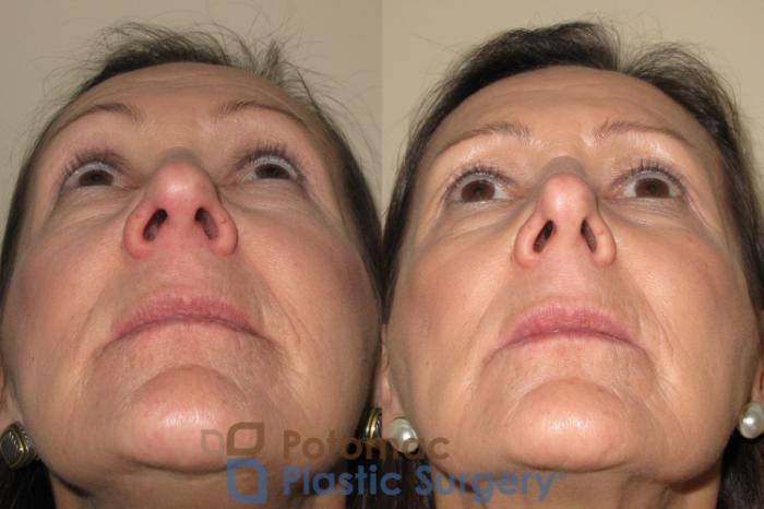 Before & After Rhinoplasty - Cosmetic Case 19 Below View in Washington DC & Arlington , DC