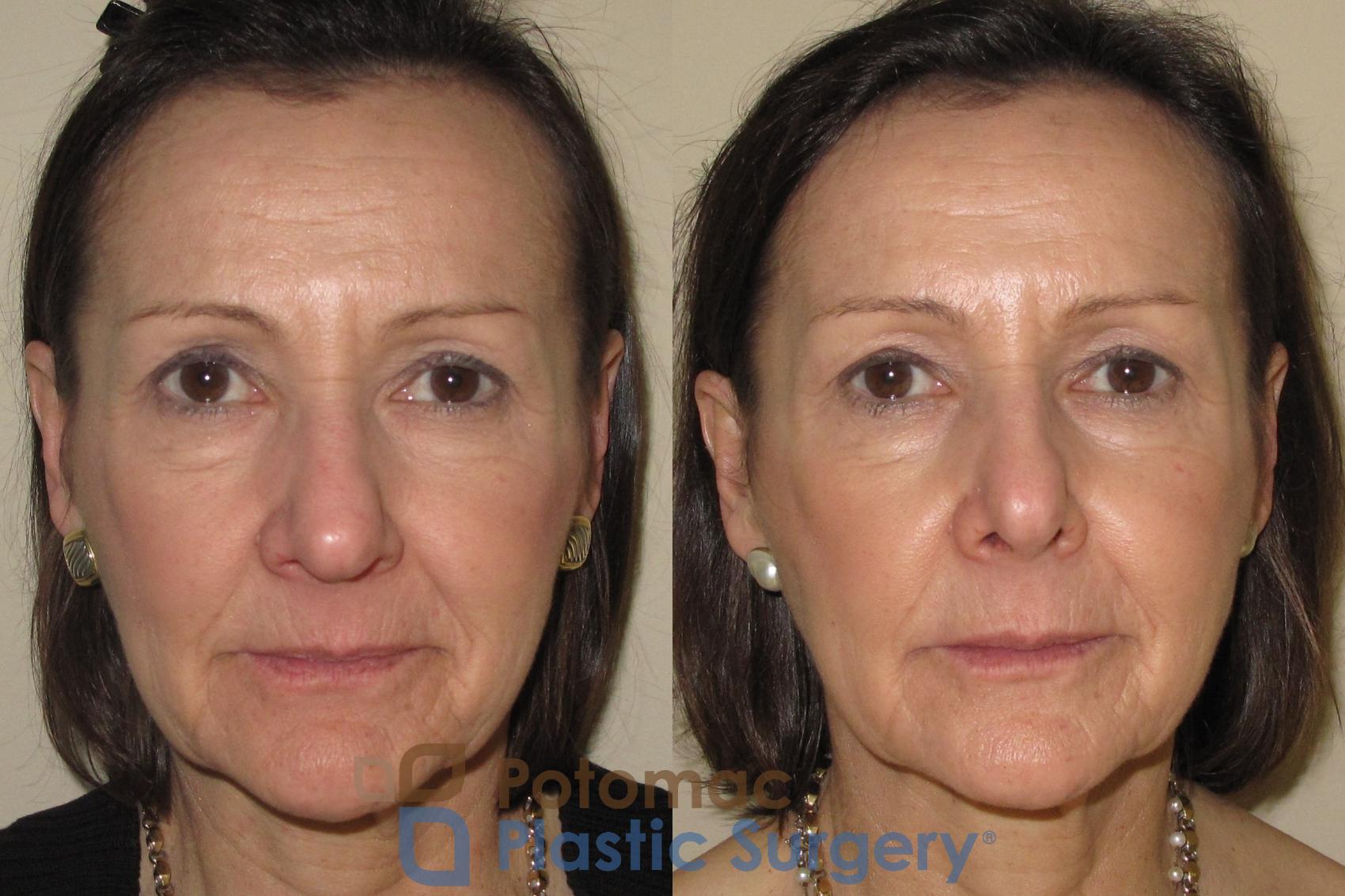 Before & After Lip Augmentation Case 19 Front View in Washington, DC