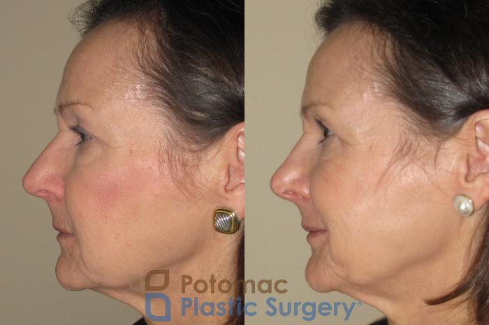Before & After Rhinoplasty - Cosmetic Case 19 Left Side View in Washington DC & Arlington , DC