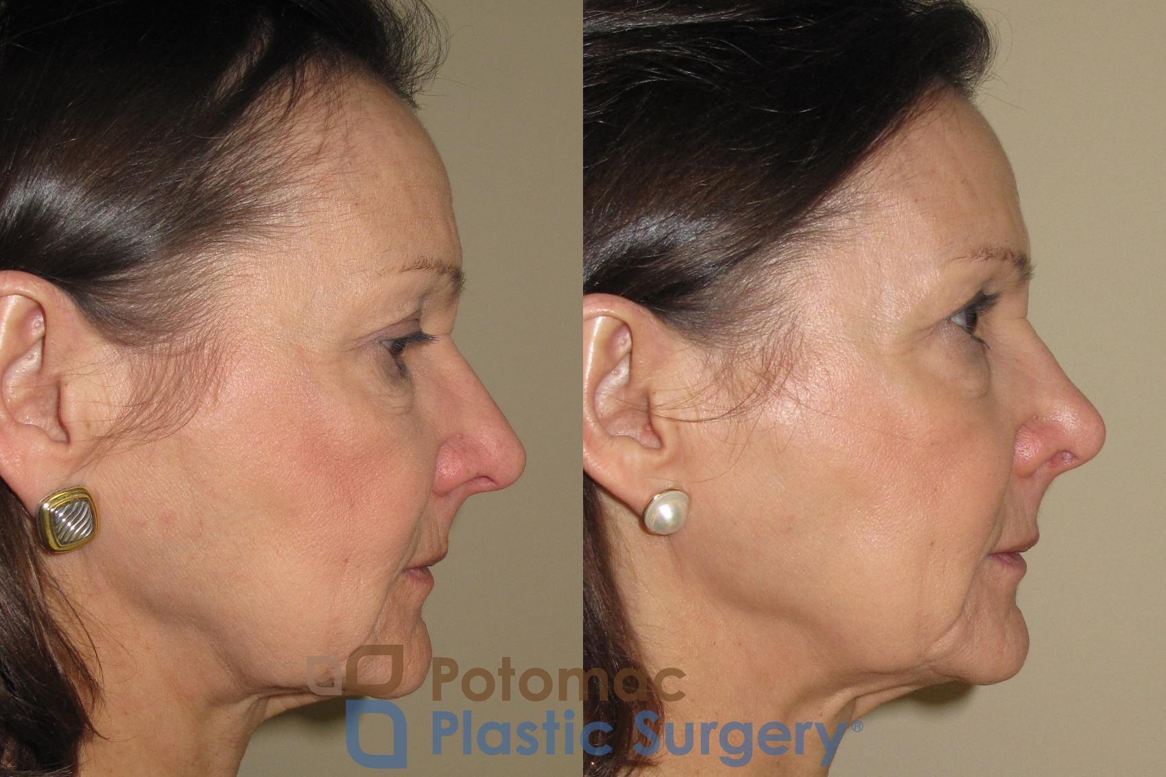 Before & After Rhinoplasty - Cosmetic Case 19 Right Side View in Washington, DC
