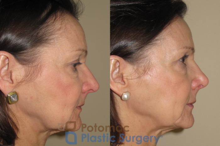 Before & After Lip Augmentation Case 19 Right Side View in Washington DC & Arlington , DC