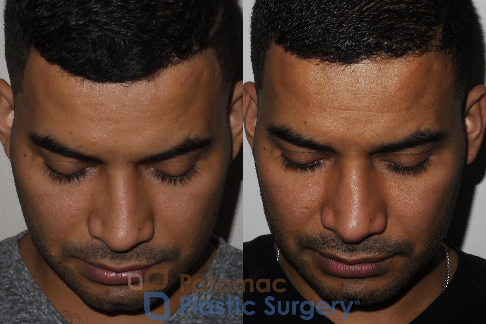Before & After Rhinoplasty - Medical Case 190 Above View in Washington DC & Arlington , DC