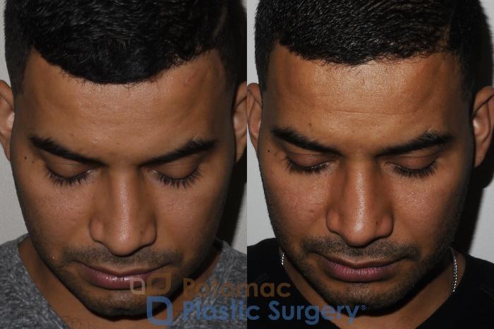 Before & After Rhinoplasty - Cosmetic Case 190 Above View in Washington DC & Arlington , DC