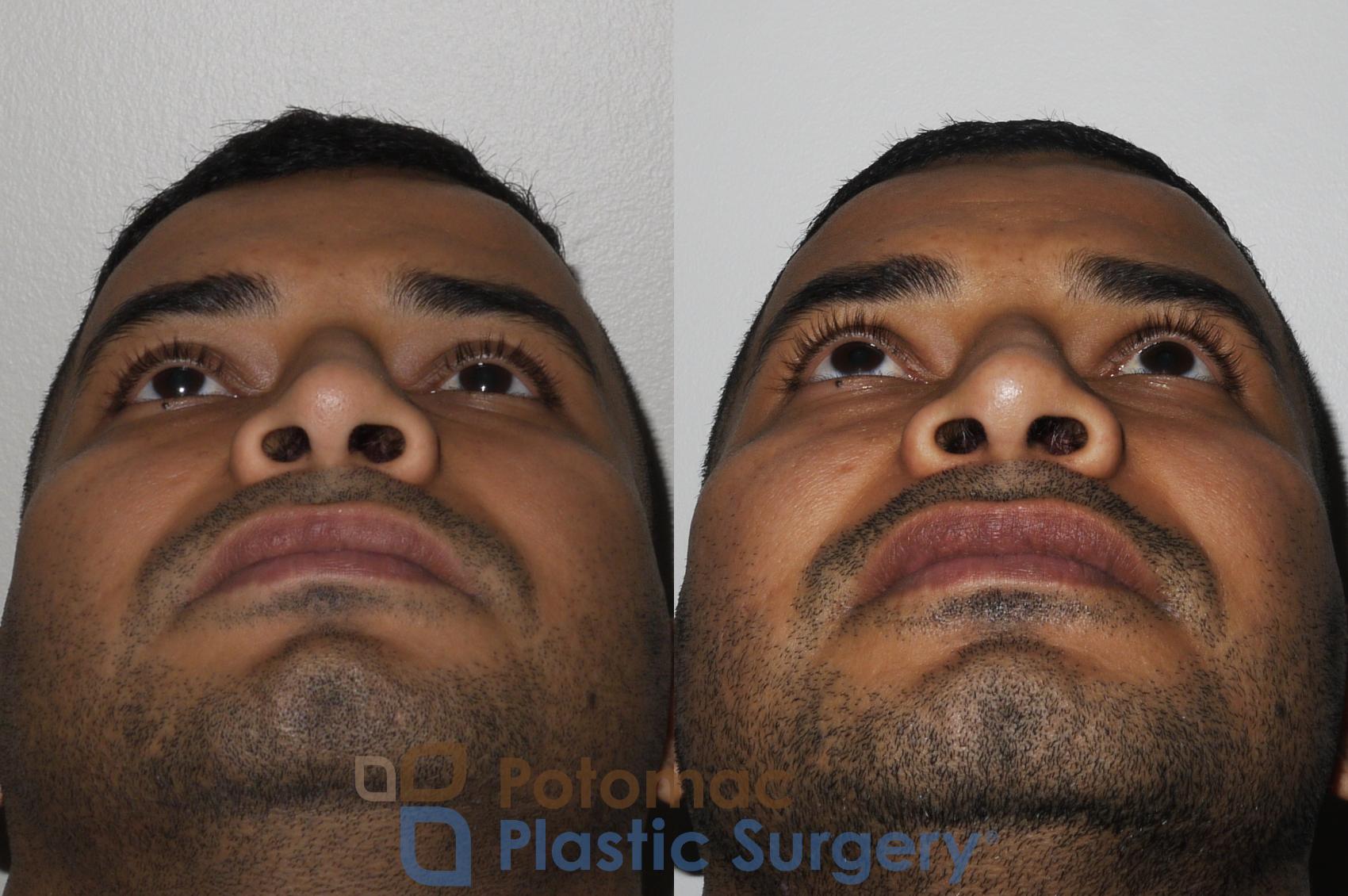 Before & After Rhinoplasty - Medical Case 190 Below View in Washington DC & Arlington , DC