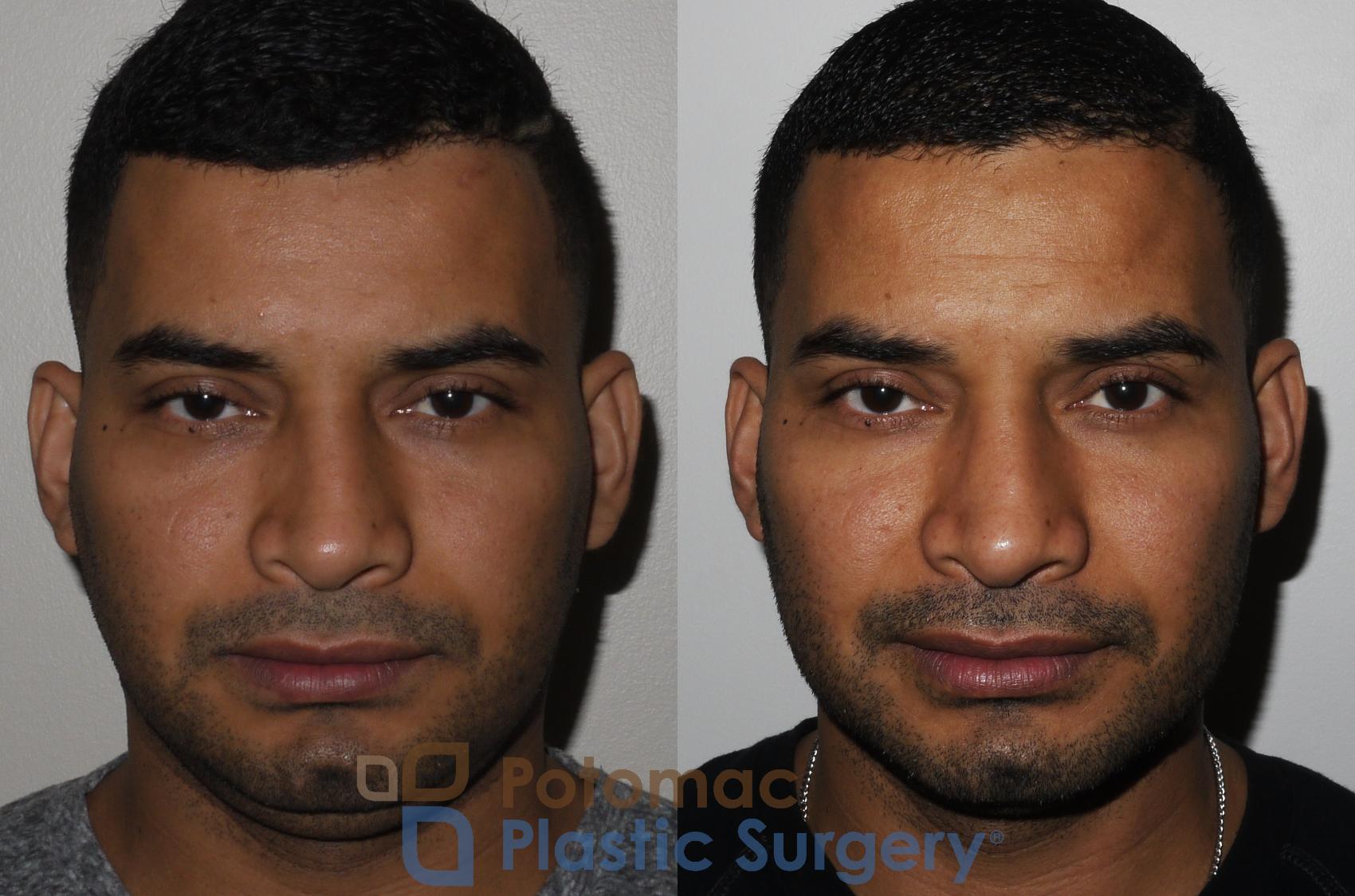 Before & After Rhinoplasty - Cosmetic Case 190 Front View in Washington, DC